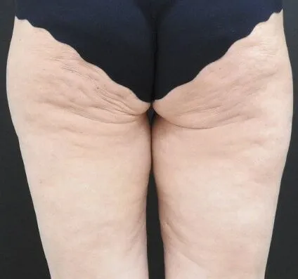 Thighs