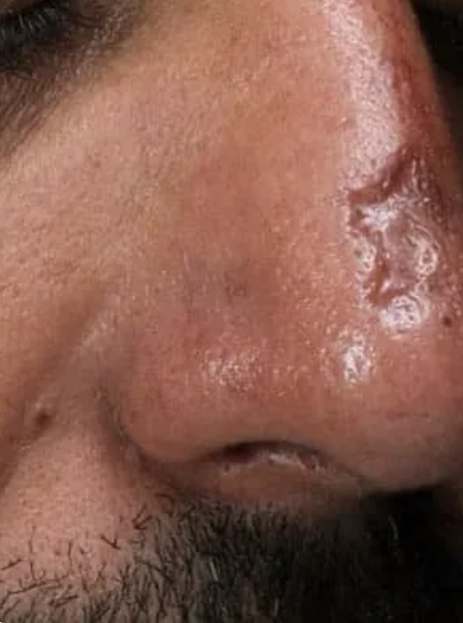 Scars Courtesy of Dr Ofir Artzi