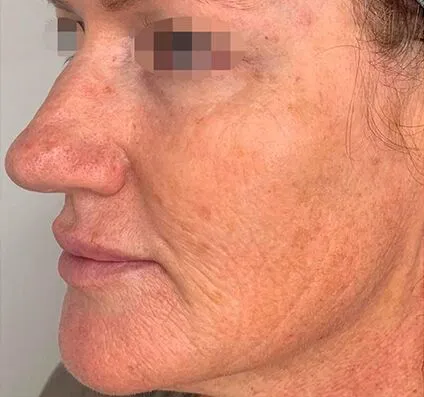 Fine Lines and Wrinkles Courtesy of Dr Pina