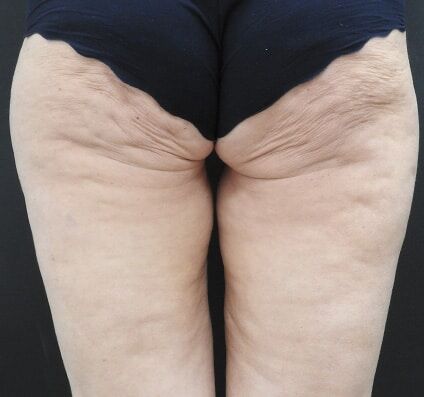 Thighs