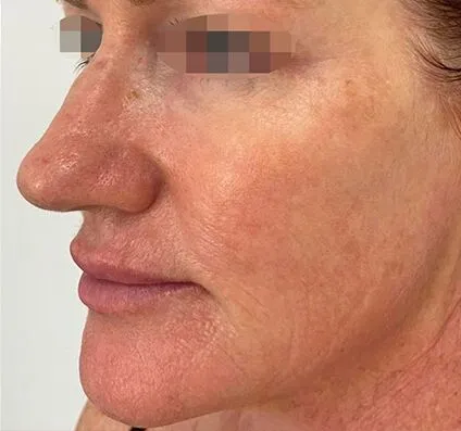 Fine Lines and Wrinkles Courtesy of Dr Pina