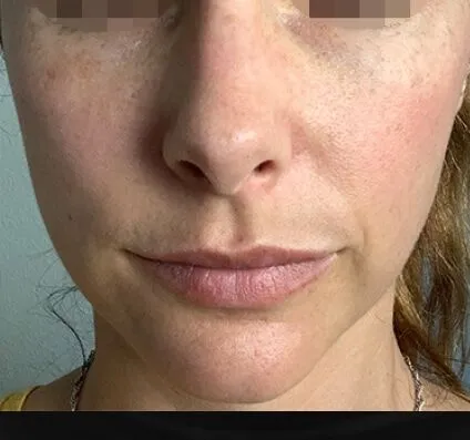 Skin Resurfacing Courtesy of Dr Pina Panchal