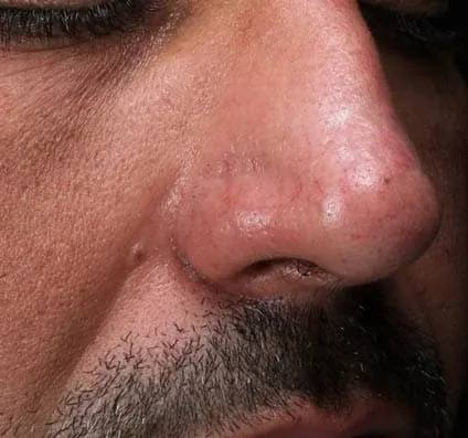 Scars Courtesy of Dr Ofir Artzi