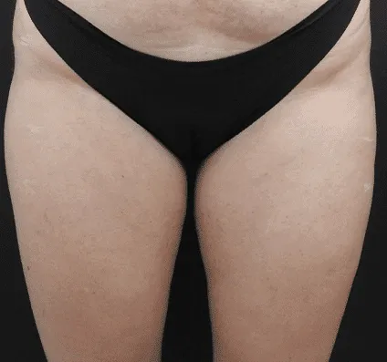 Thighs
