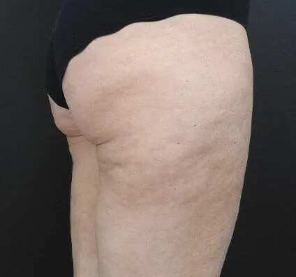 Buttocks