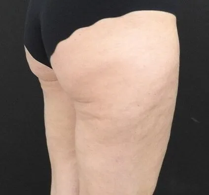 Buttocks