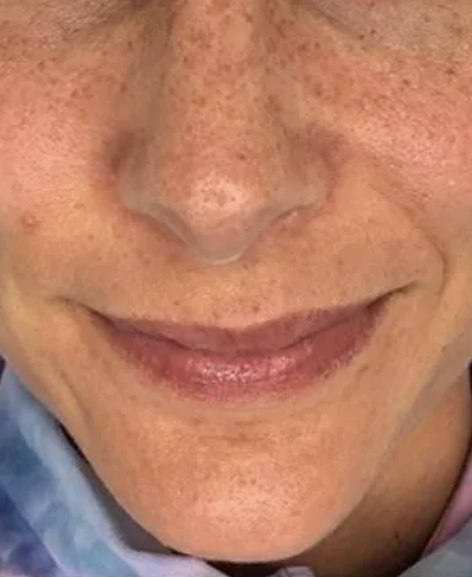 Skin Resurfacing Courtesy of Dr Pina Panchal