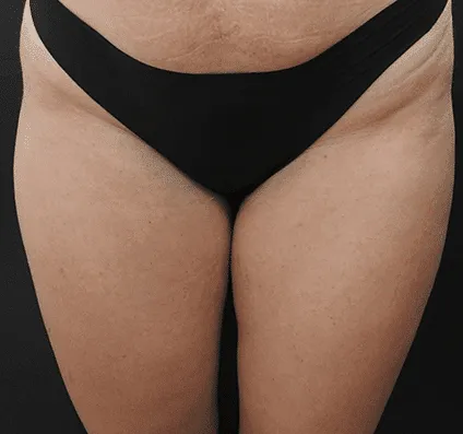 Thighs
